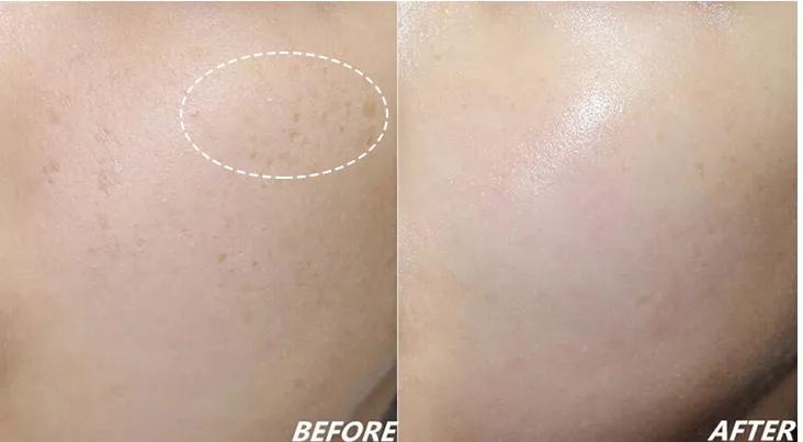 祛脸上斑点色斑的小妙招,一个动作教你如何淡化色斑