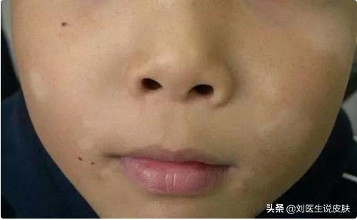 23岁女孩白癜风怎么治疗,29岁女人白癜风自愈