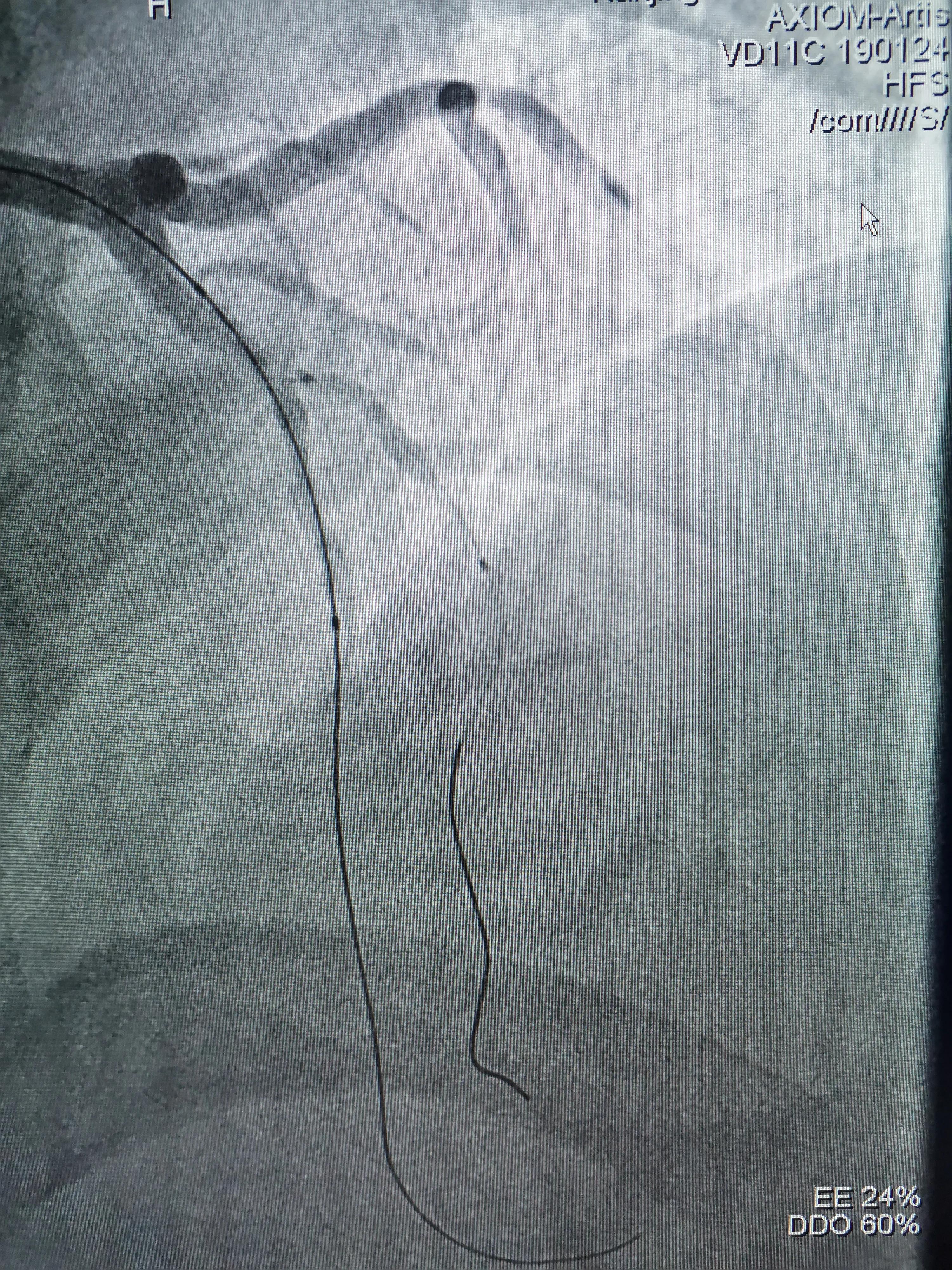 atp术式治疗冠脉分叉病变,冠脉分叉处堵塞能治吗