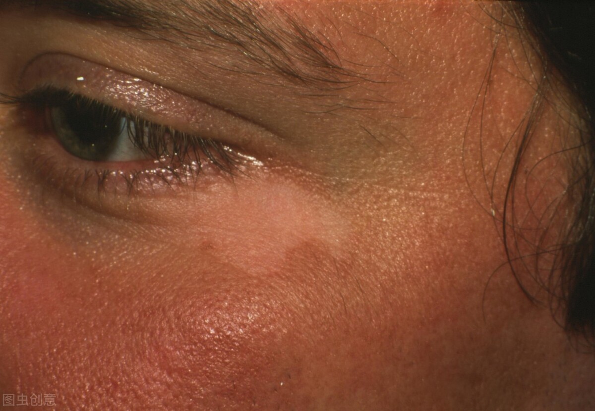 胳膊上有一小块白癜风是怎么回事,身体出现白癜风是什么原因