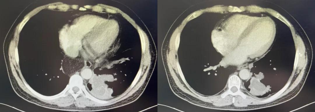 咳嗽10多天了有白痰细菌感染,咳嗽是肺部真菌感染吗