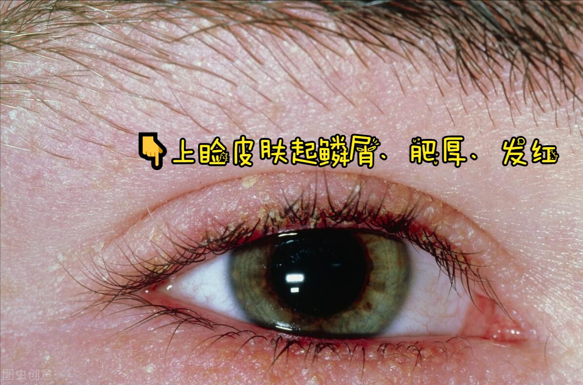 胳膊痒一挠就起皮屑怎么回事,身上痒痒一挠就掉皮屑怎么回事