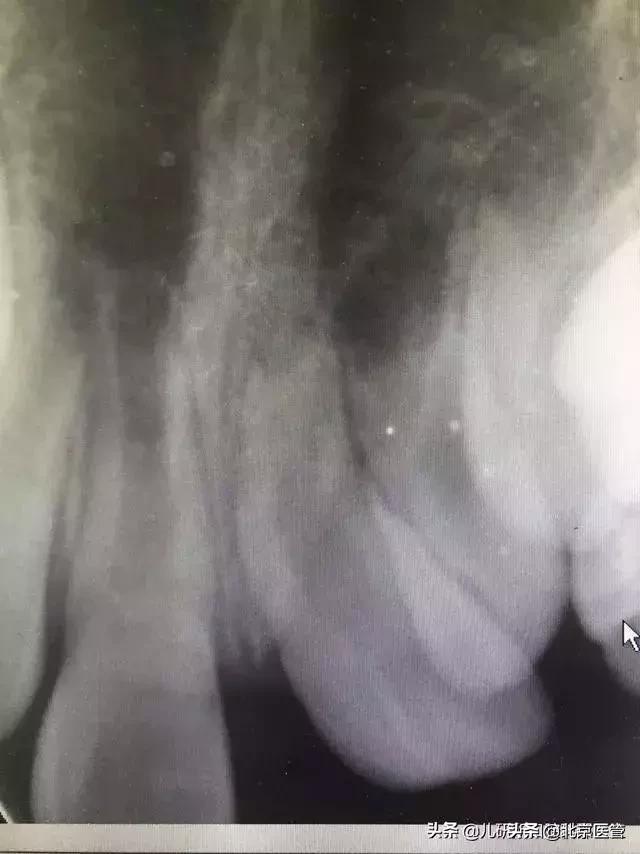 儿童换牙注意事项换牙顺序看这里,换牙期的小朋友注意什么