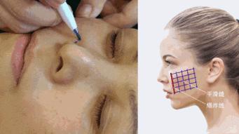 年龄大了想祛法令纹又不想动刀,泪沟法令纹不用动刀就能掩盖掉