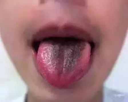 老中医提醒舌头4种异常,舌头一旦出现这个信号马上找中医