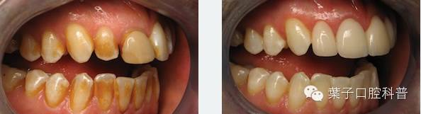 葉子口腔科普,口腔健康自查