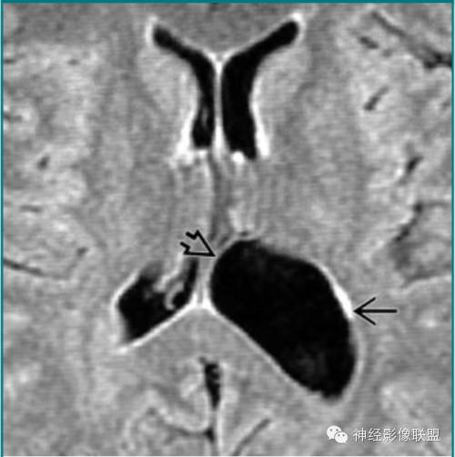 各种囊肿的症状,颅内囊肿18-19mm严重吗