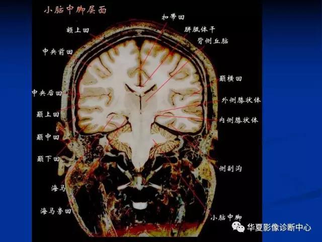 电子版头颅ct与mri断层解剖,头颅mri血管解剖与分段详解