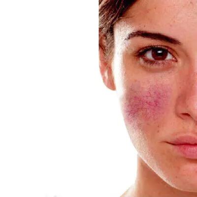 擦护肤品后皮肤刺痛是什么原因？