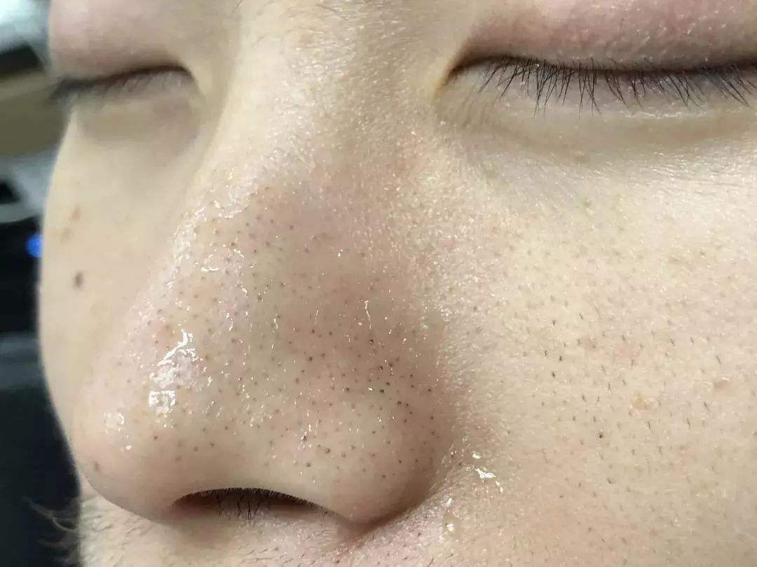 油光型毛孔用什么清洁面膜,补水保湿去黑头清洁面膜