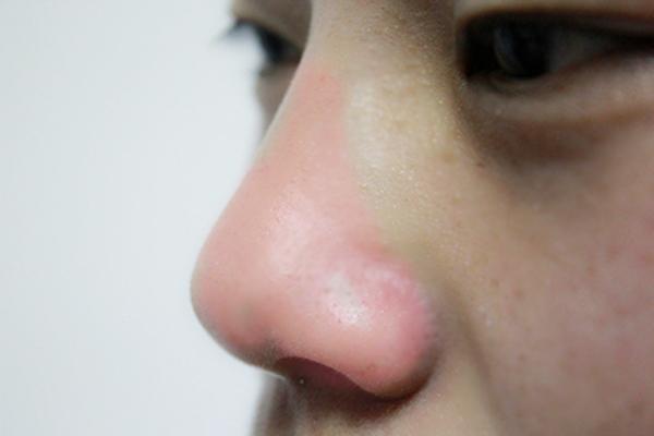 鼻子有黑头能挤出白色东西怎么办,鼻子挤黑头出白色东西是什么