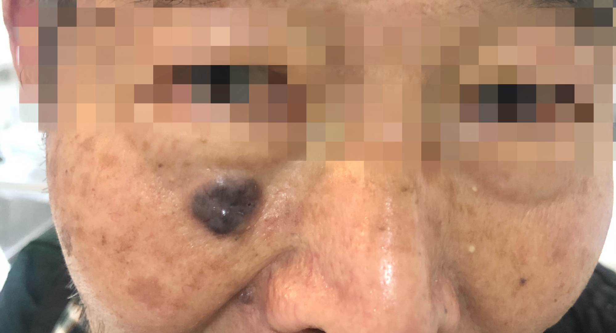 三厘米的痣手术切除要不要做皮瓣,头皮上有个凸起的痣要不要切除