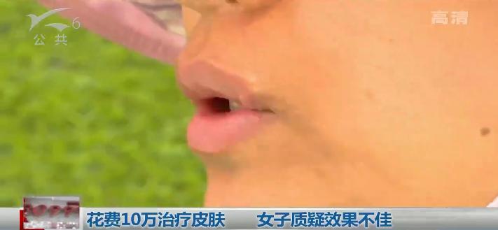 女子花万元治痘不见好转,花10万治疗痘坑