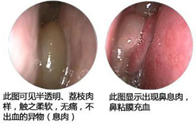 鼻炎长期鼻塞吃什么药,老鼻炎患者怎么治疗