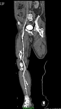 沈阳六院血栓专家,沈阳六院治疗深度静脉血栓