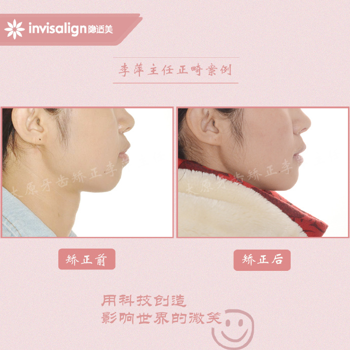 成都牙齿有缝隙怎么矫正,牙齿拥挤矫正前两天不痛正常吗