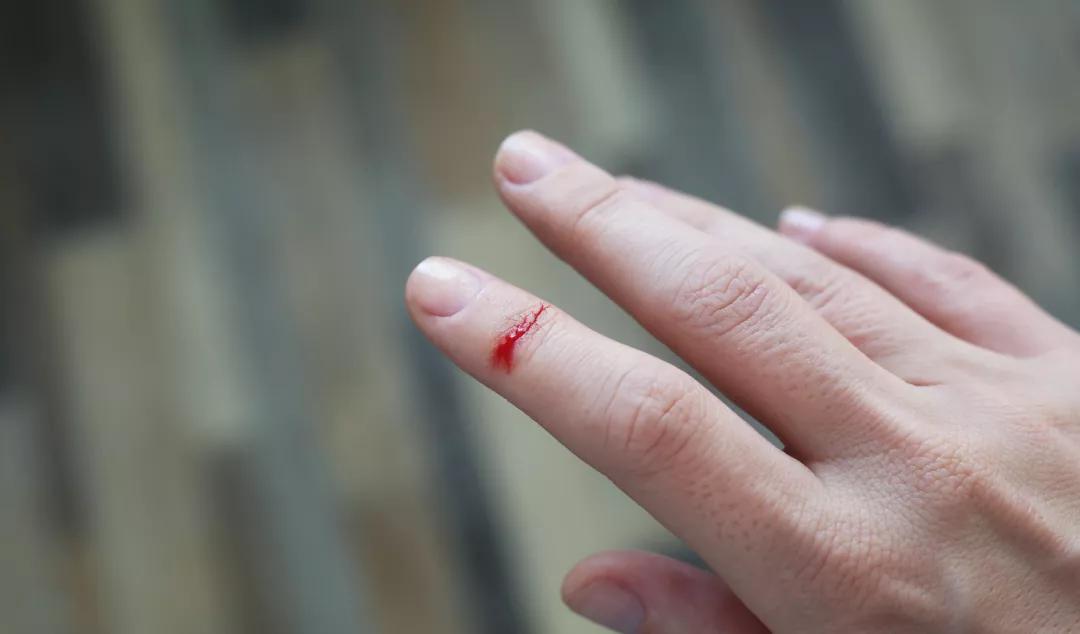刀割伤了不打破伤风针可以吗,小孩子割伤手要不要打破伤风针