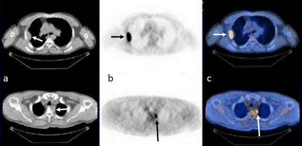 居里夫妇、镭、“派特洗梯”（PET/CT），与医学影像有什么关系？