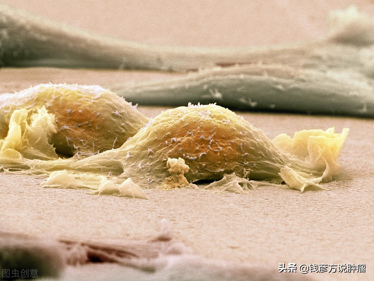 良性肉瘤怎么治疗能根除,肉瘤后期长得很大了还能治疗吗