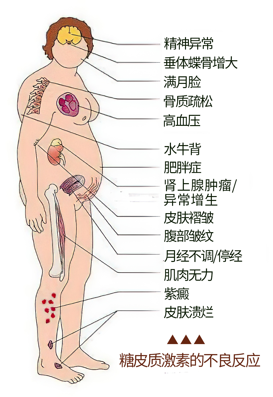 骨关节炎注射玻璃酸钠要注射几次,膝骨关节炎治疗方法及效果