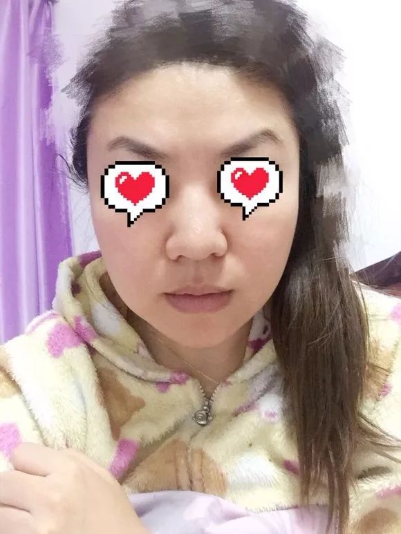 41岁考虑线雕和拉皮哪个好,线雕40岁后的感受