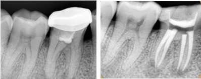 根管和补牙戴全瓷牙冠一共多少钱,为什么要做根管治疗不能直接补牙