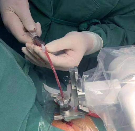 突发脑干出血机器人来救命