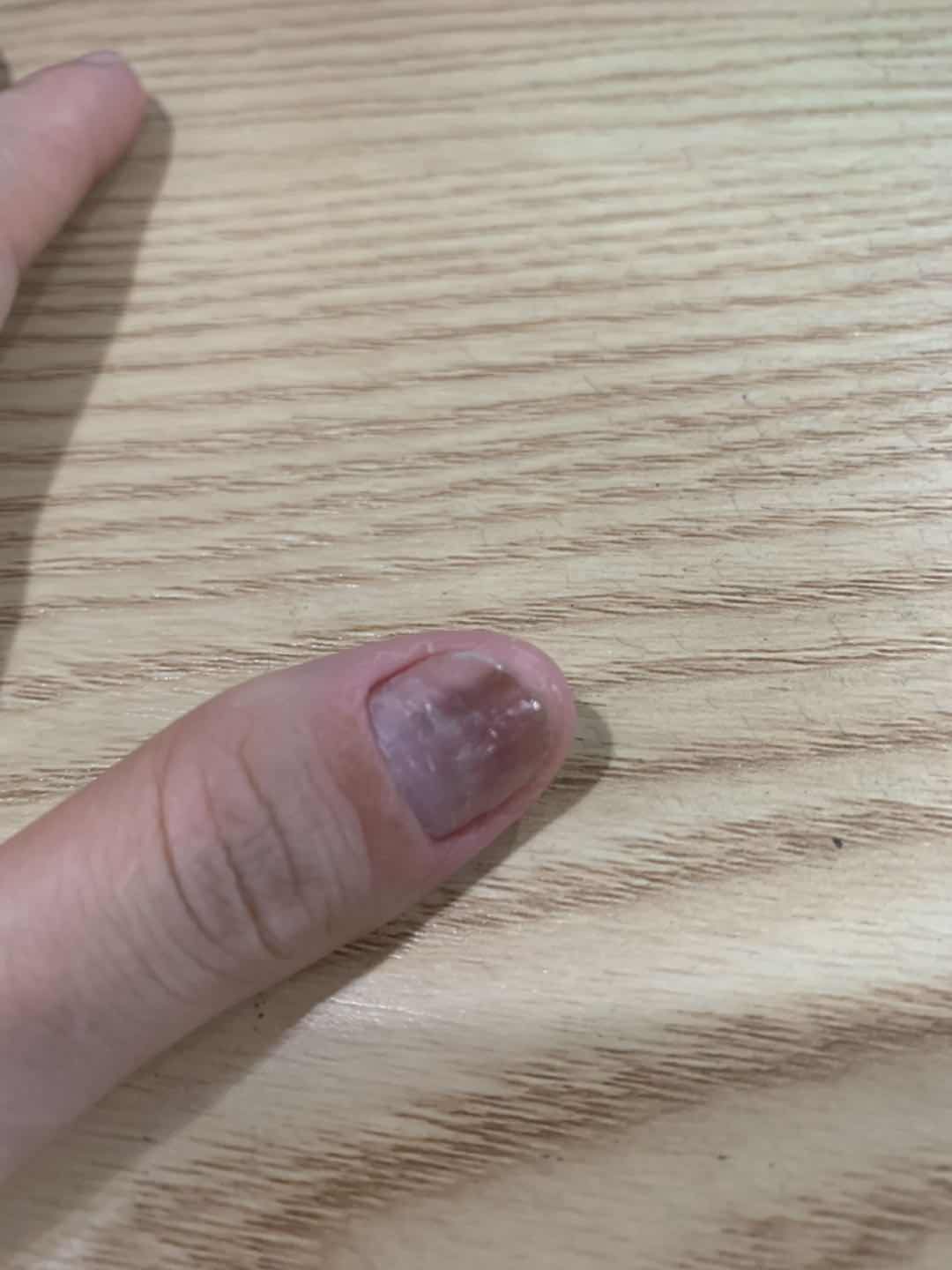 分享乙肝治愈路,分享养生知识辨别灰指甲