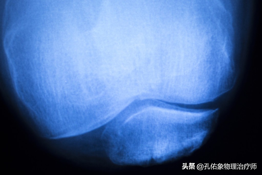 膝痛如何做康复,膝痛5种原因