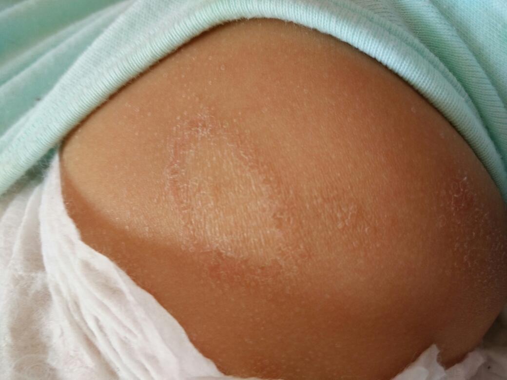 为什么宝宝的湿疹反反复复,宝宝湿疹为什么总是反反复复