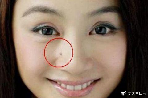 脸上长痣越来越多怎么回事,想把脸上的痣去掉去医院哪个科