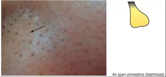 痘痘为什么越来越多如何正确祛痘,祛痘痘的效果是长痘痘还是消痘痘