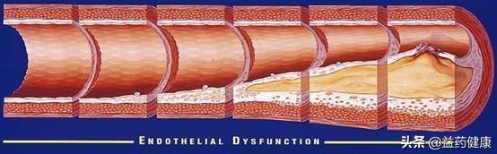 脂肪肝导致脾功能亢进,轻度脂肪肝会引起阳痿早泄吗