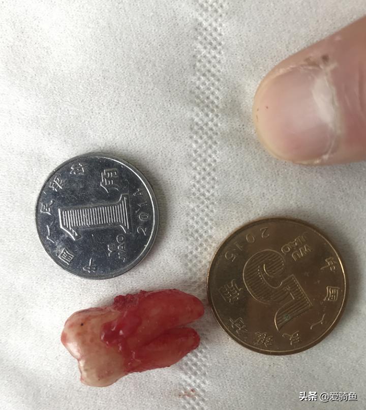 拔一颗长出来的智齿大概要花多少,拔一颗智齿前前后后花了快两千