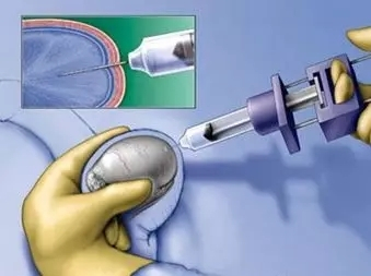 中医无精症怎么恢复生精功能,男性无精症特效配方