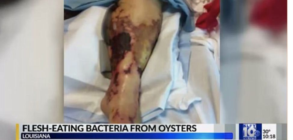 紧急！全澳多地出现“吃人菌”，感染后如同丧尸！24小时可吃一人