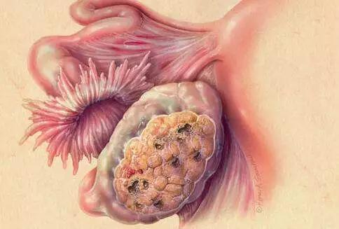 以为怀孕结果是癌症,以为怀孕了结果绝经了