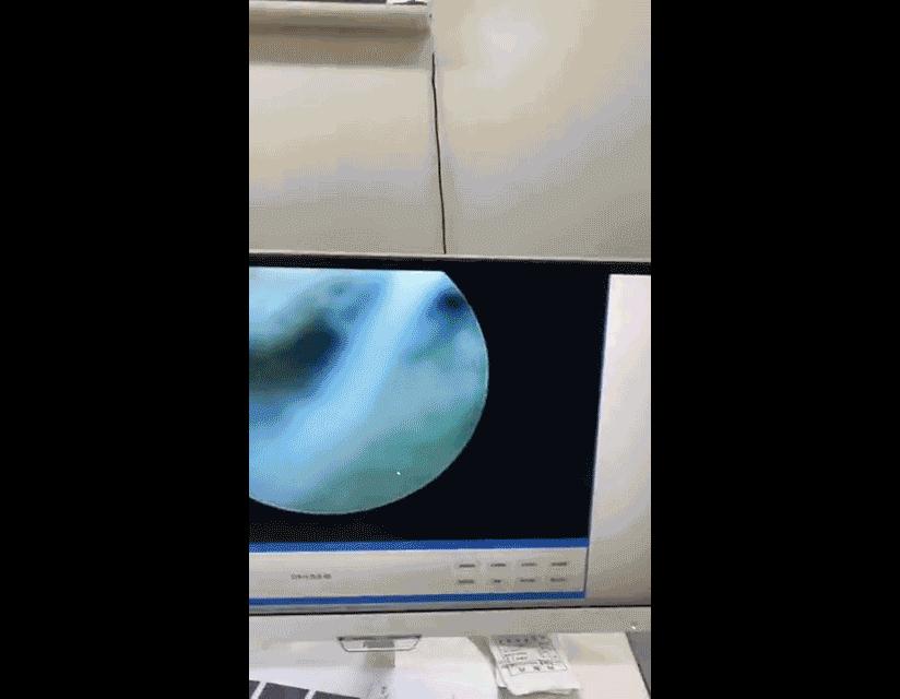 老年人膝关节退变原因,老年膝关节退变怎么治疗