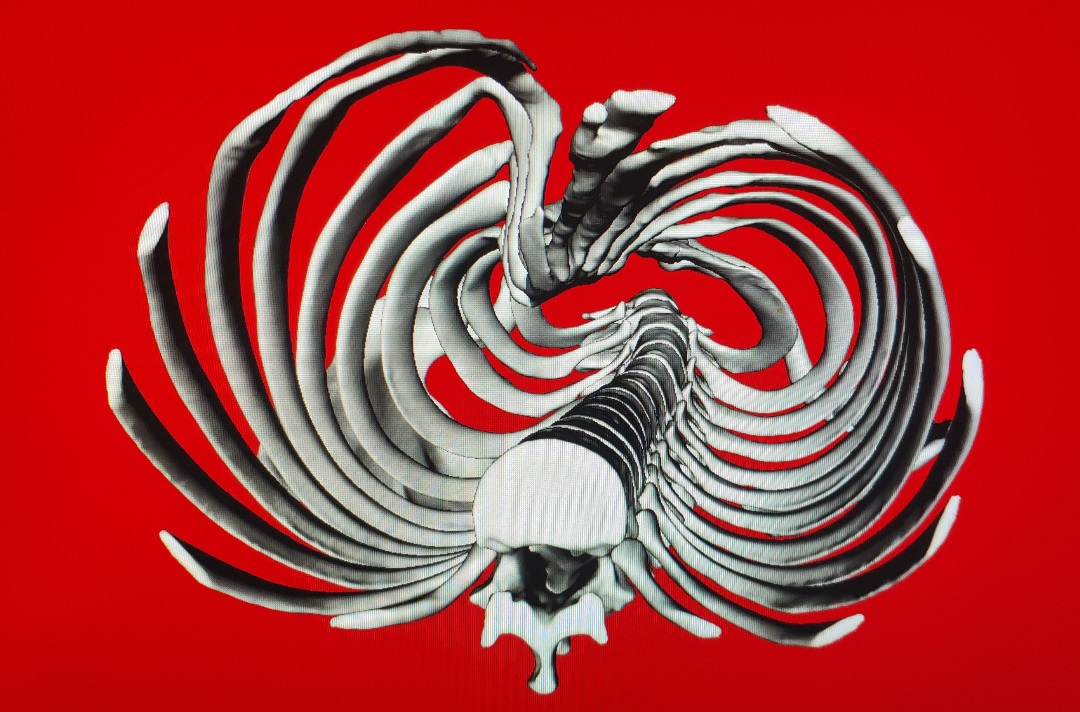 胸廓畸形矫正术后恢复,再创奇迹