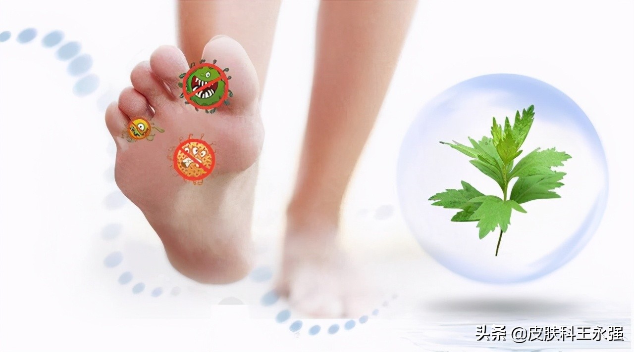 脚气如何根除教你四个方法,夏天脚气怎么根除小妙招