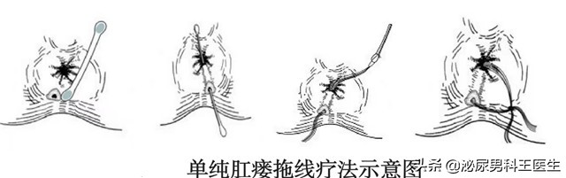 肛瘘不治是不是头疼,肛瘘患者不敢手术