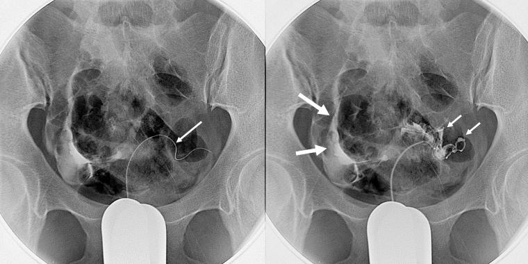 介入别人婚姻导致其怀孕犯法吗,介入科对生育的影响