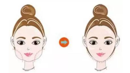 30岁下颌缘提升还有用吗,30岁下巴后缩能矫正吗