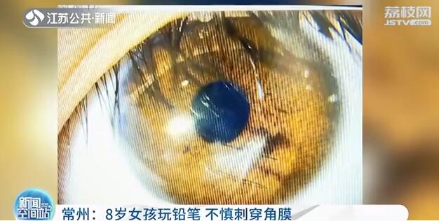 眼睛被孩子戳到六小时还有刺痛感,6岁小孩眼睛被铅笔戳了怎么办