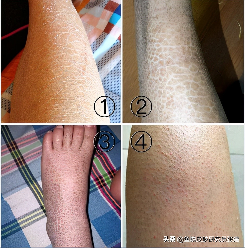 小腿上像鱼鳞一样的皮肤怎么治疗,鱼鳞皮肤怎么治疗孩子