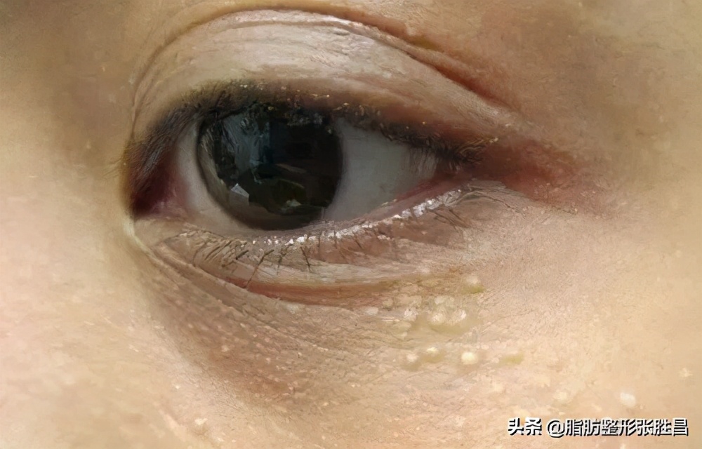 眼部长脂肪粒要怎么解决,眼部长脂肪粒能自愈吗