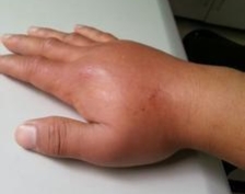 如果不小心被蜜蜂叮伤应该怎么做,宝宝被蜜蜂蛰了第一时间怎么办