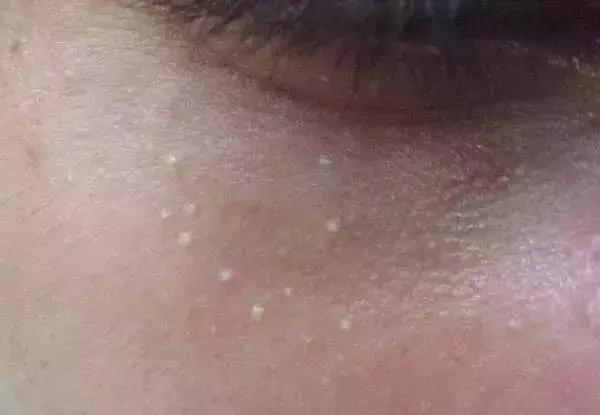 粉刺是什么应该怎么治,粉刺怎么样才算好了