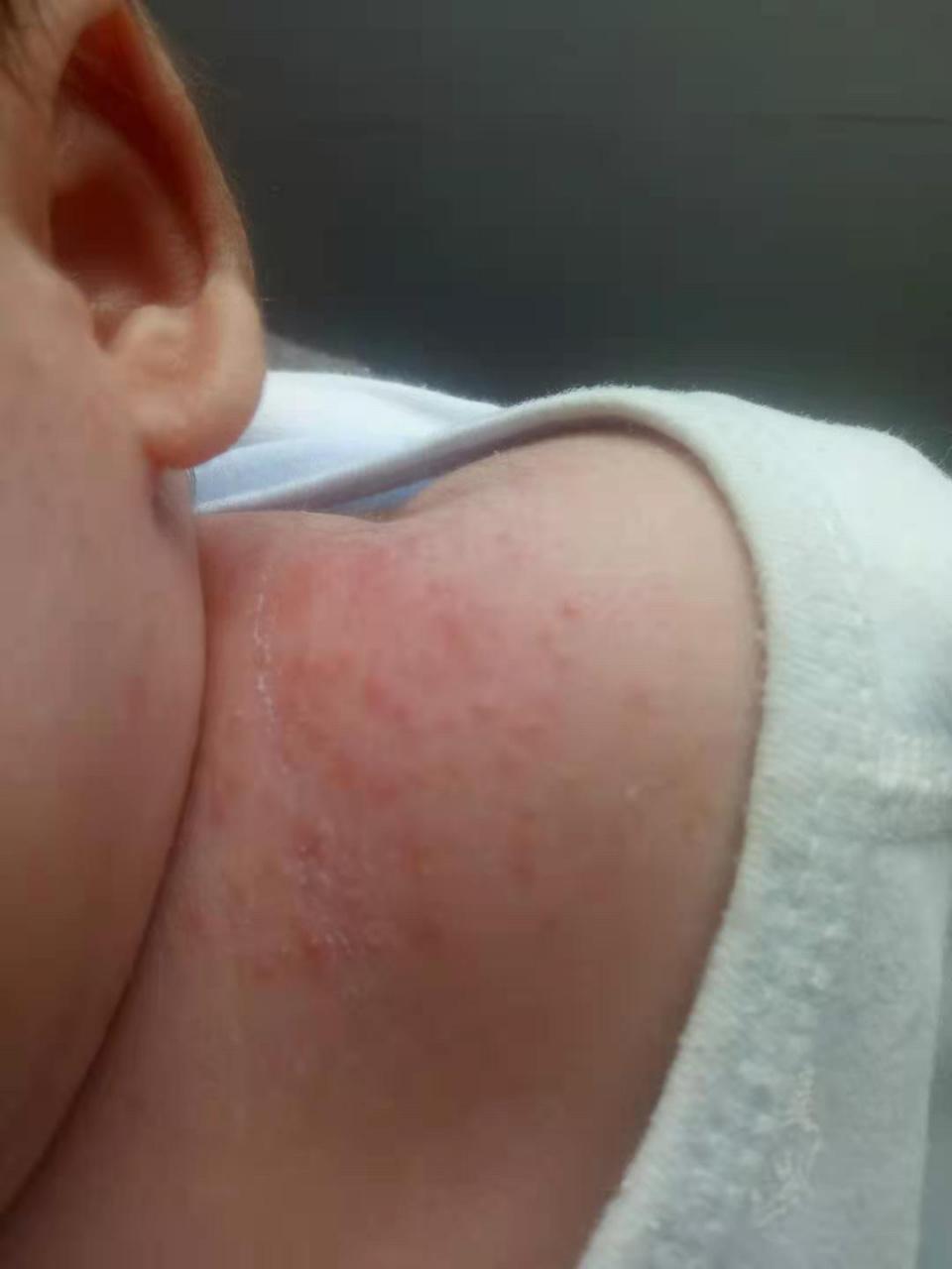 宝宝湿疹严重反反复复怎么办,宝宝湿疹反反复复一直不好怎么办