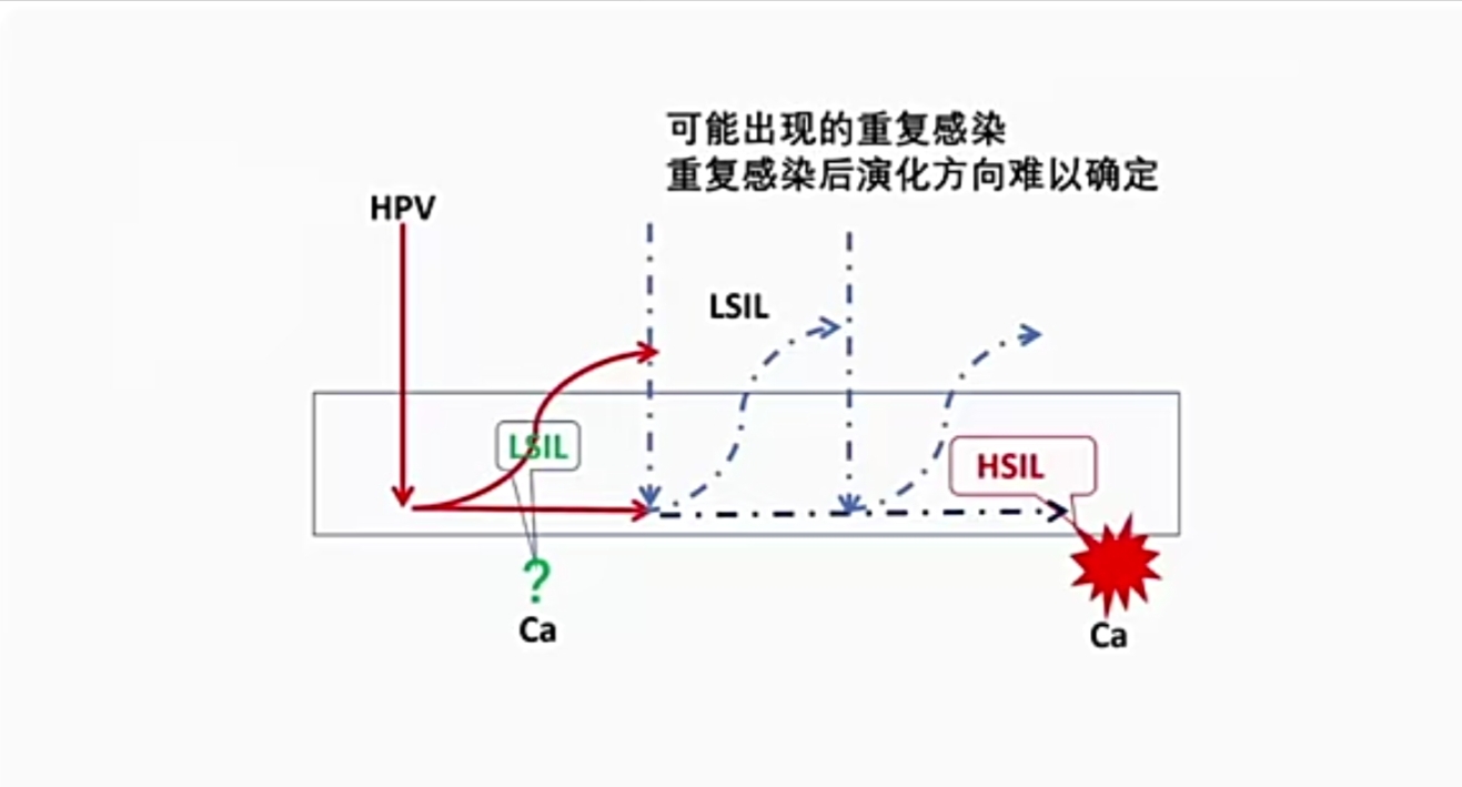 宫颈高级版鳞状上皮内病变指南,宫颈lsil低级别鳞状上皮内病变